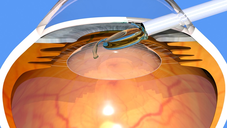 Intraocular lens implanting inside the lens capsule