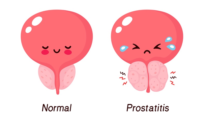 BPH prostate 