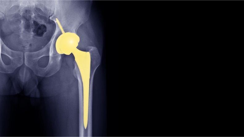 Film X-ray radiograph show Avascular necrosis (AVN) or Osteonecrosis (ON) disease treated by total hip replacement (THR) surgery. Highlight on prosthesis with free space. Medical technology concept - Image 