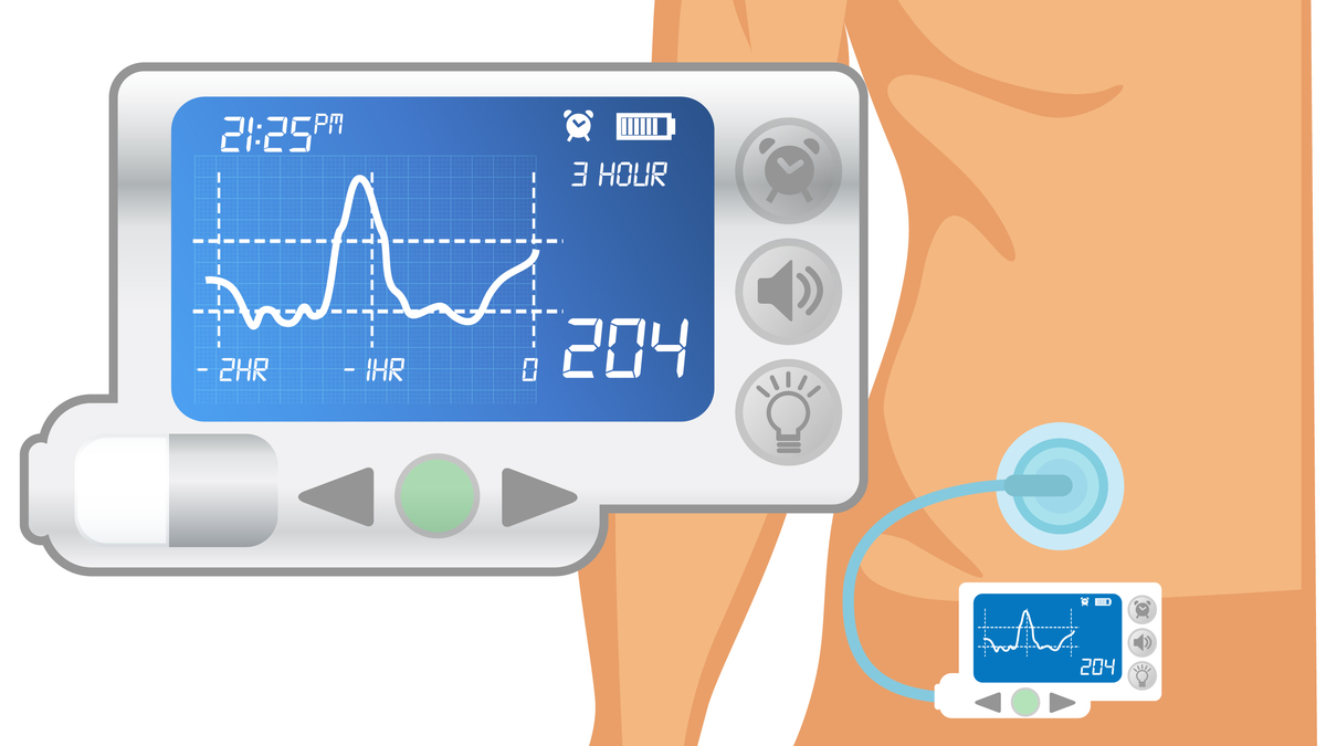 Инсулиновая помпа картинки