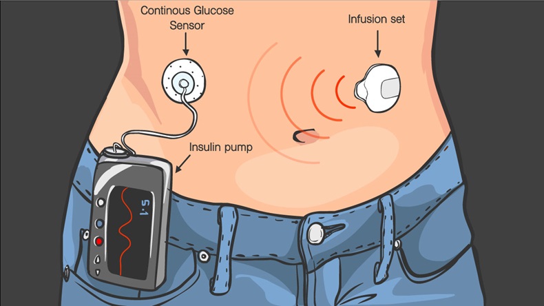 Insulin Pumps for Diabetes Patients Vector İllustration