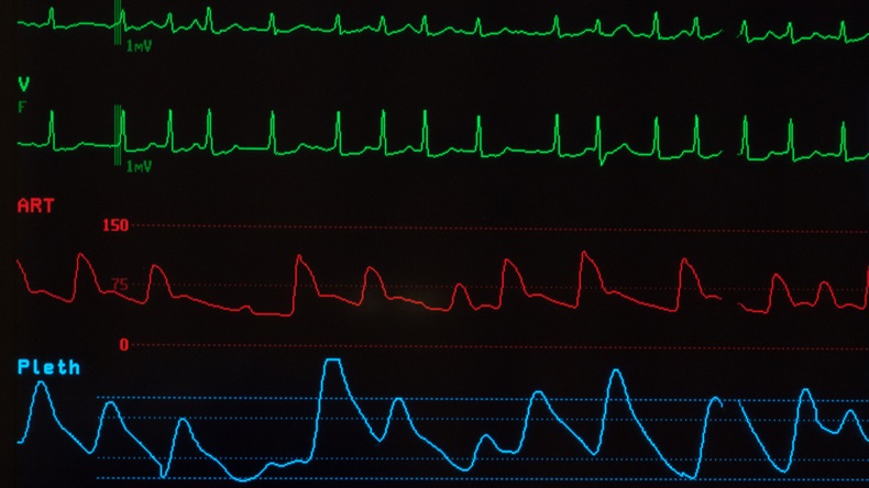 Medical monitor with green lines of an abnormal ECG showing atrial fibrillation, a red line for the arterial blood pressure and a blue line for the oxygen saturation against a black background.