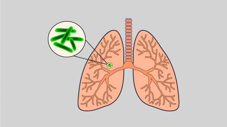 Tuberculosis - vector illustration on gray background