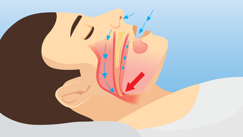 Anatomy about air way of man with sleep apnea