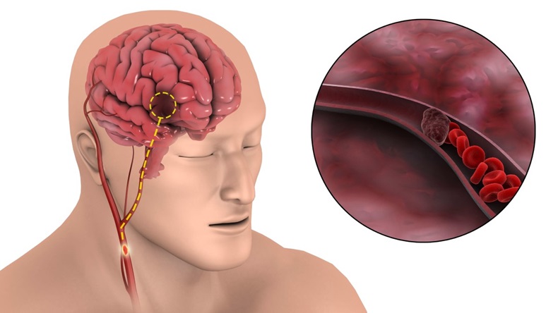 A medical illustration of an ischemic stroke