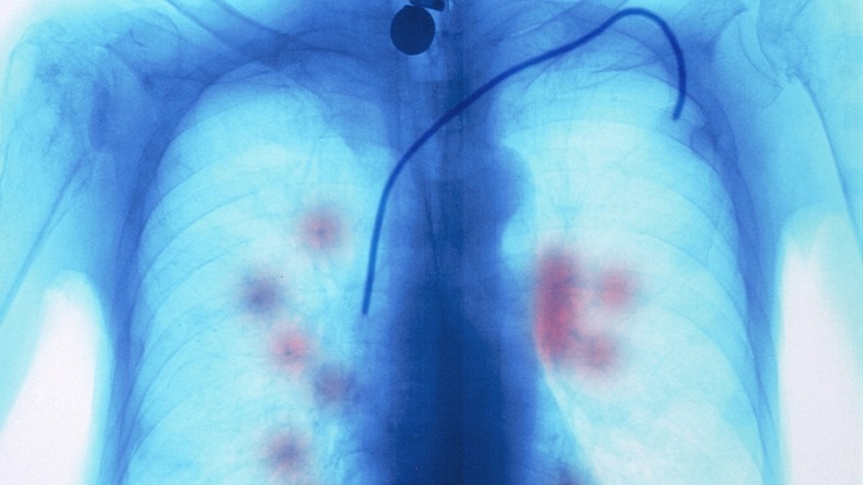 Colored X-ray of a patient with metastatic lung cancer