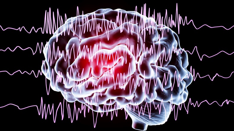 Image of brain and EEG waves during epileptic seizure.