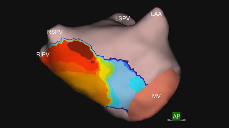 AcQMap non-contact charge density cardiac mapping system