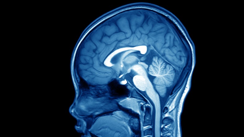 magnetic resonance image (MRI) of the brain human